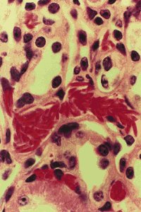 Sickling Damage in the kidney of a Ryan lab transgenic mouse; Barinaga, 1997 : p 803